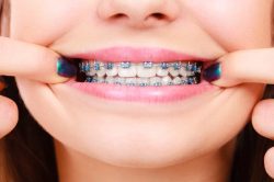 Fixing Gap Teeth Braces Options | Braces for Teeth Gap