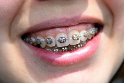 Overbite Before And After Braces | Normal Overbite | Overbite After Braces