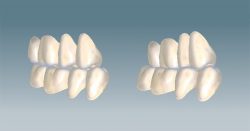 Normal Bite Occlusion | Improper Vs. Normal Teeth Bite