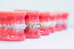 Straight Talk About Adult Braces | Types of Metal Braces sunny isles beach