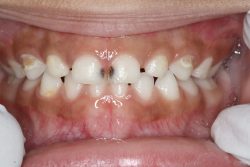 Affordable Dental Implants in Houston