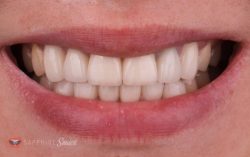 How Single Tooth Dentures Can Restore Your Smile?