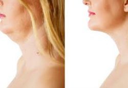 Facelifts Houston, TX | Cosmetic Surgery | Premiere Surgical Arts