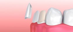 How much do veneers cost? What problems do veneers fix? What are dental veneers made of? We help ...