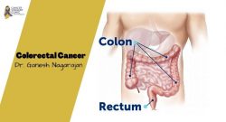 Best Doctor For Colorectal Cancer Treatment