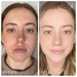 Chemical Peel Near Me