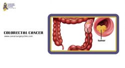 Colorectal Cancer Treatment By Dr Ganesh Nagarajan