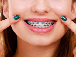 Affordable Dental Braces In Houston