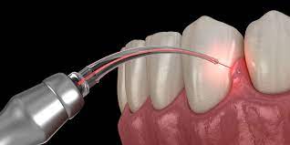 Find a Reputable Dentist for Porcelain Veneers in Houston, TX