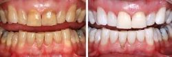 Dental Onlays Vs Inlays | Repair a Damaged Tooth – URBN Dental