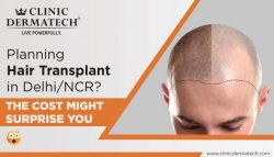 best hair transplant in Delhi