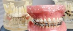 How Can I Find An Affordable and Good Orthodontist Near Me?