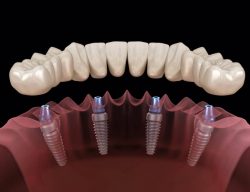 Finding The Best Dental Implants Near Me