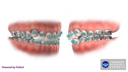 Do I Need Comfort Dental Braces? | Comfort Dental Teeth Braces