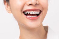 Bracket Braces For Kids | Bracket Teeth Braces For Children