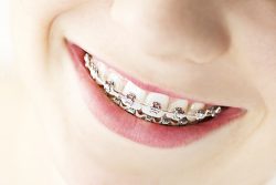 Pros and Cons of Teeth Retainers from Orthodontist in North Miami