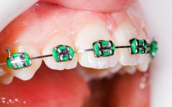 What to Know – Getting Braces from Orthodontist Nearby | North Miami FL