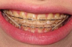 Braces On Top Or Bottom Teeth | Bottom Teeth Braces Cost