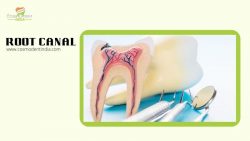 Root Canal Treatment in Gurgaon