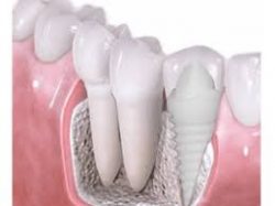 How Long is Tooth Implant Recovery Process | Dental Implant Procedure