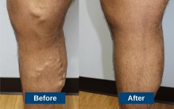 Varicose Veins Treatment in Jaipur