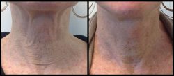 Morpheus8 Skin Tightening Treatment