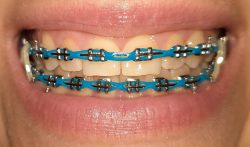 Double Power Chain Braces | Braces Power Chain | Power Chain Colors