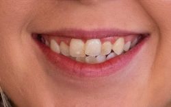 What To Do If Your Filling Falls Out: Don’t Panic, Just Call The Dentist – Emergency ...