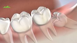 Managing the Cost of Wisdom Teeth Removal Houston