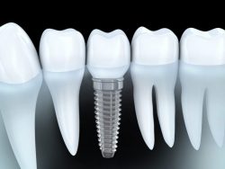 Best Dental Implants in Houston, TX