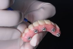 Same Day Dental Implants in Houston TX