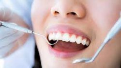 How Much Does a Deep Cleaning Teeth Cost