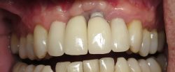 Dental Implant Center in Houston, TX