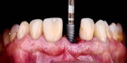 Best Dental Implants in Houston, TX