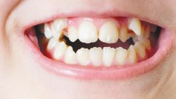 Primary to Permanent Teeth Progression Process | IVANOV Orthodontic Experts