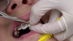 Common Questions About Orthodontics | WHAT IS ORTHODONTICS?