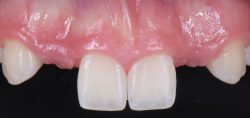 What is Canine Substitution with Missing Lateral Incisors?