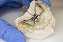 Fix Crowding with Haas Expander | Fixed Palatal Expander for Upper Jaw