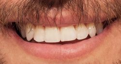 Decayed and Broken Tooth | Uptown Dentist in Houston TX | Urbn Dental