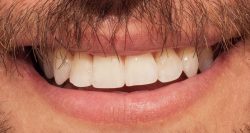 Chipped or Cracked Tooth Causes and Repair – Urbn Dental