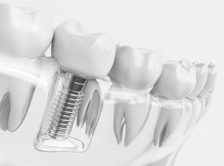 How Does a Dental Crown Work – Dentist Houston TX