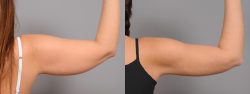 Arm Liposuction in Houston