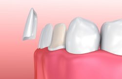 How Much Do Porcelain Veneers Cost?