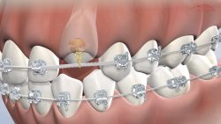 Impacted Canine Tooth Treatment | Human Canines Teeth