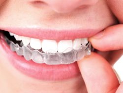 Are Invisible Braces The Same as Invisalign | Invisible braces and Invisalign