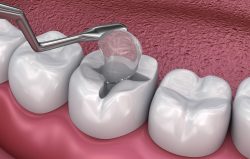 Fix Cavity on Front Tooth | Composite Front Tooth Cavity Filling or Bonding