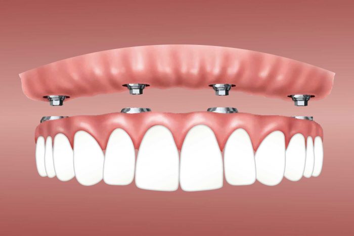 Stages of the Dental Implant Procedure: