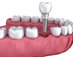 Affordable Dental Implants Near Me