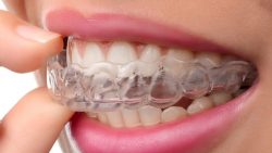 Invisalign Dentist Near Me