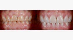 How much do veneers cost per tooth?